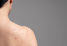 “Say Goodbye to Shoulder Acne: 10 Home Remedies That Actually Work!” Shoulder Acne